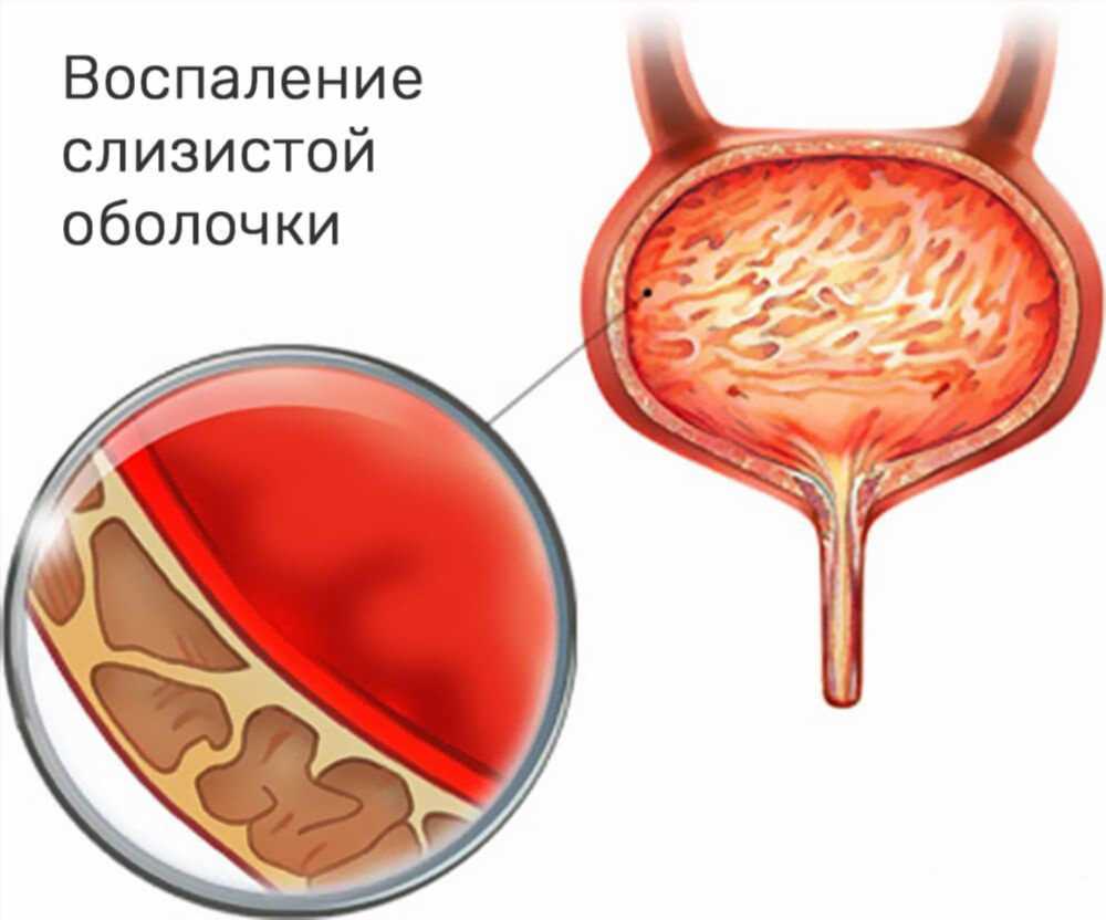 Цистит у женщин: симптомы, причины и методы лечения