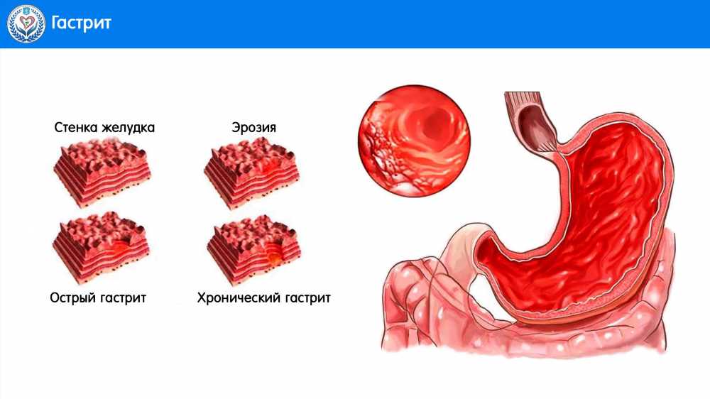 Эффективные методы лечения гастрита у детей: роль медикаментов