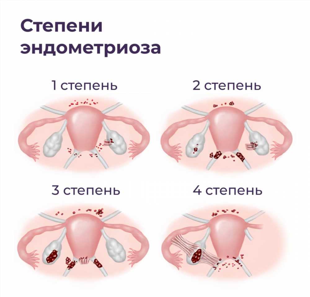 Эндометриоз: симптомы, лечение и поддержка для женщин