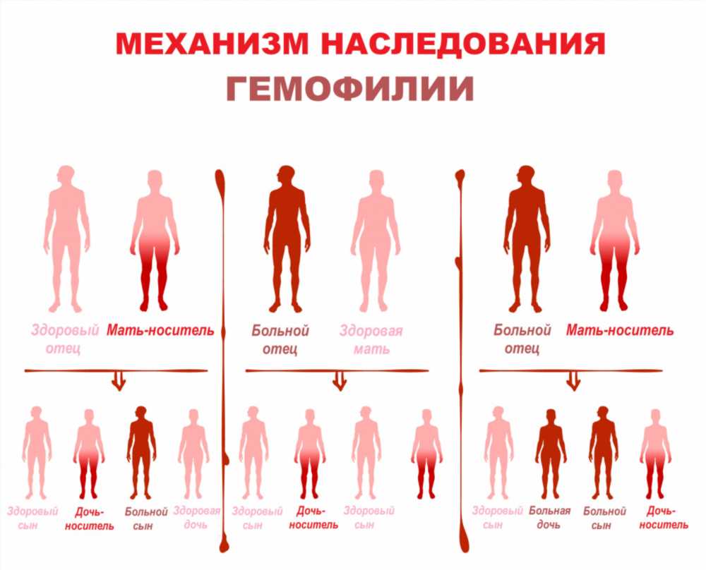 Гемофилия: Признаки, Формы и Лечение