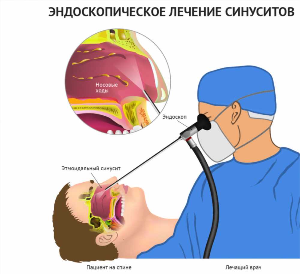 Как быстро вылечить насморк при простуде: эффективные методы и советы