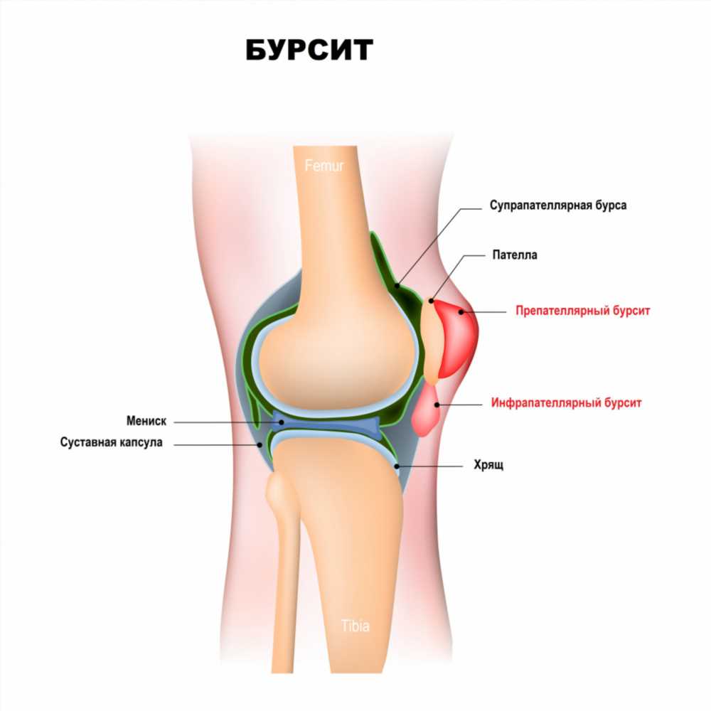 Как избавиться от бурсита: эффективные методы лечения и профилактика