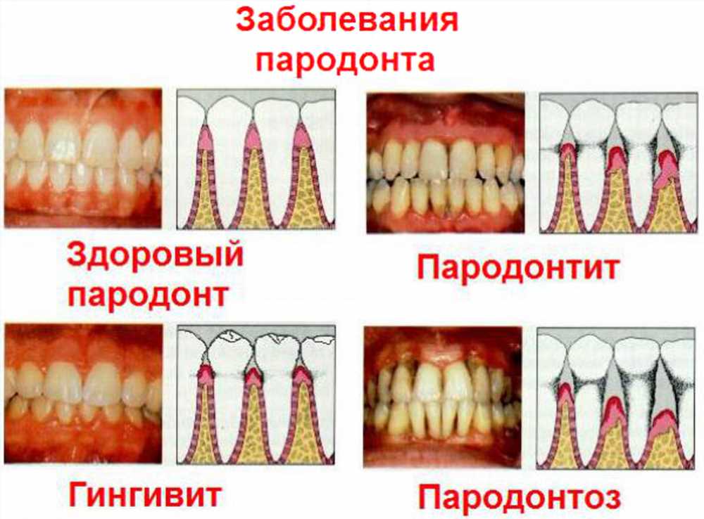 Как облегчить боль при прорезывании зуба мудрости: советы и рекомендации