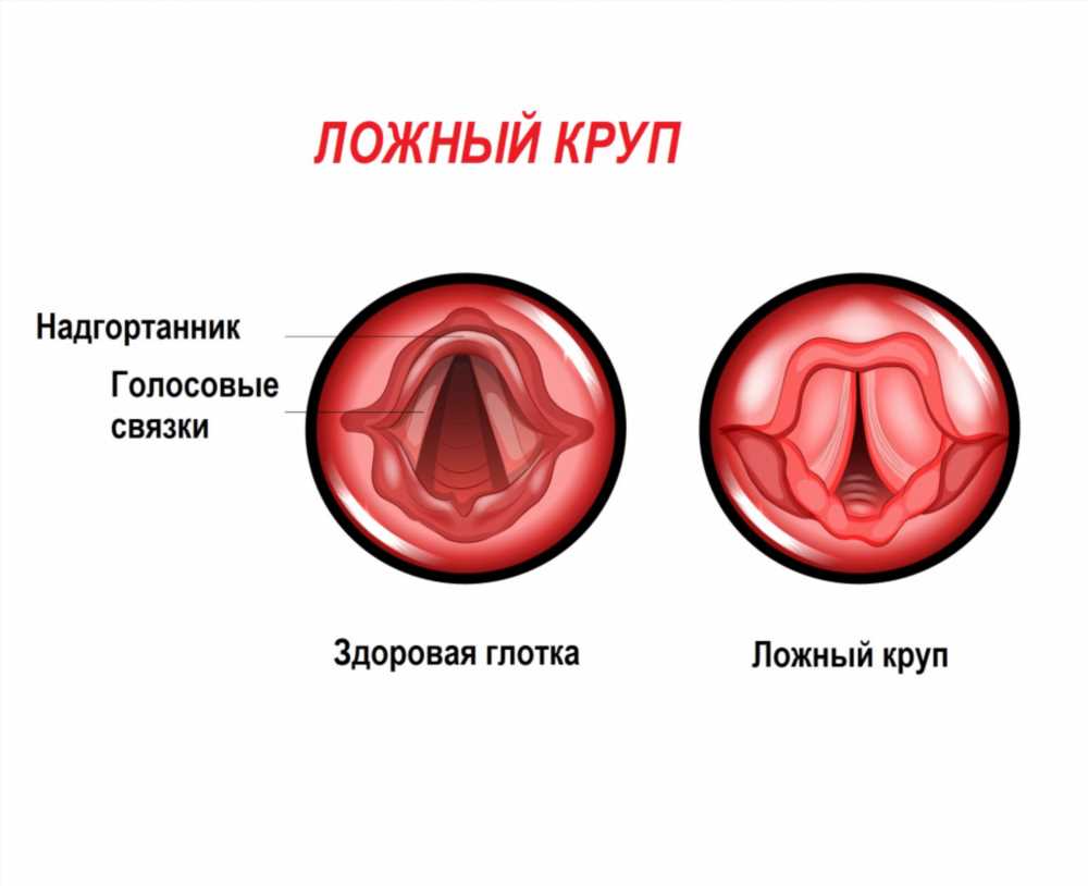 Как распознать ложный круп у ребенка: симптомы, диагностика и лечение