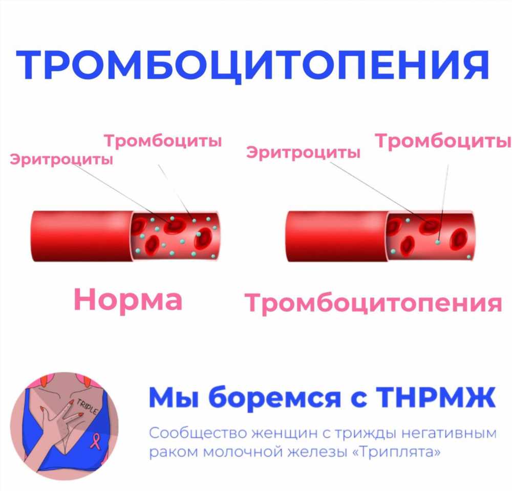 Как снизить тромбоциты в крови: эффективные методы и советы