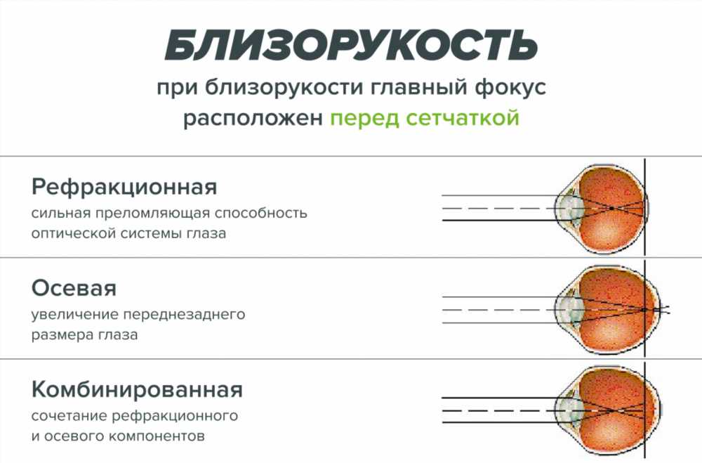 Офтальмоскопическая классификация: Понимание основ и важность диагностики