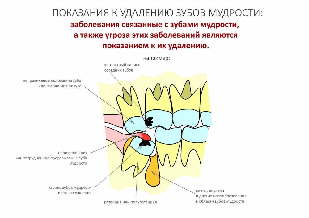 Перикоронит: Опасность и Последствия. Как проходит процедура удаления капюшона зуба мудрости и надреза десны