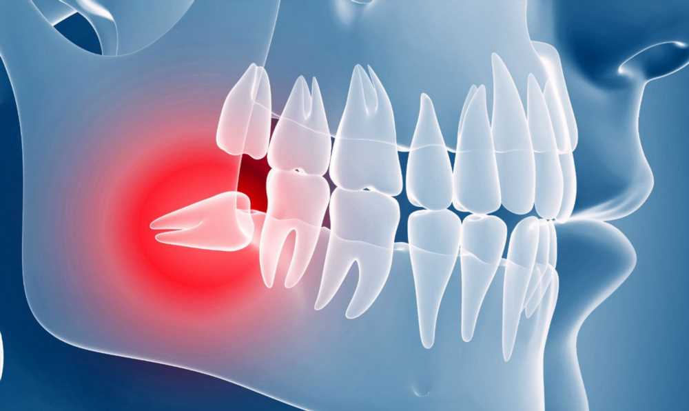 Ретинированный и дистопированный зубы: симптомы, лечение и методы удаления