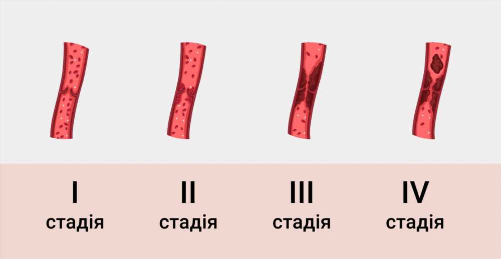 Все, что вам нужно знать о флебите: симптомы, причины и лечение