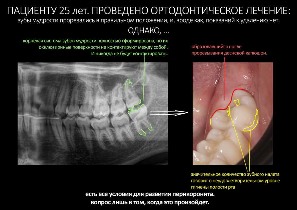 Все, что вы должны знать о прорезывании зубов мудрости: симптомы, причины и лечение
